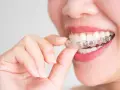 Kobieta z różowymi ustami zakłada przezroczysty aparat Invisalign na zęby.