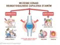 Wczesne oznaki reumatoidalnego zapalenia stawów: sztywność stawu, opuchlizna, zmęczenie, gorączka, utrata apetytu.