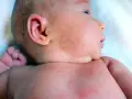 Skóra noworodka pokryta czerwonymi kropkami, widoczne potówki u noworodka na twarzy i szyi.