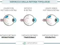 Illustrazione mostra tre tipi di distacco della retina: con rottura, tradizionale e essudativo. Il buco nella retina è evidenziato in uno dei casi.