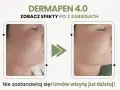 Dermapen 4.0 na co? Zobacz efekty po 3 zabiegach: skóra wygładzona, bez niedoskonałości. Umów wizytę!
