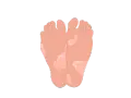Pieds avec des zones dépigmentées, soulevant la question : pourquoi la peau de mes pieds s'enlève ?