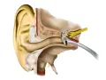 Coupe anatomique de l'oreille montrant les structures internes, y compris le tympan et les osselets, qui peuvent être affectés par une distorsion sonore oreille.