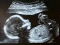 Ultraschallbild eines Babys, das sich im Mutterleib entwickelt. Ein kleiner Arm ist zu sehen, was auf einen ultraschall jungen hindeutet.