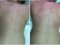 Comparación de la espalda antes y después de un intento de como depilarse la espalda uno mismo. La imagen de la derecha muestra irritación y enrojecimiento.
