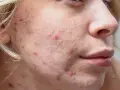 Jak wygląda zapchana cera i jak ją skutecznie leczyć?