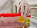 Ręka w rękawiczce laboratoryjnej wybiera pojemnik z żółtym płynem. W tle widać rząd podobnych pojemników. Badanie może wykazać ketony w moczu, a odwodnienie.