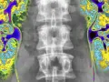 Kolorowa scyntygrafia kości pokazuje kręgosłup i obszary o zwiększonej aktywności metabolicznej, sugerujące potencjalne problemy.