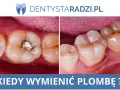 Kiedy jeść po dentyście? Poradnik: plomba, wyrwanie, wybielanie