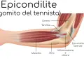Illustrazione anatomica del gomito del tennista, evidenziando infiammazione e dolore all'epicondilo laterale.