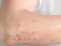 Skóra na łokciu z zaczerwienionymi, swędzącymi zmianami, które mogą być objawem reakcji na histaminę.