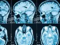 Guz mózgu objawy psychiczne: jak rozpoznać niebezpieczne sygnały
