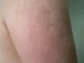 Piel de fresa con pequeños puntos oscuros, como si fueran semillas, en un brazo.