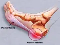 Illustration av fotens anatomi som visar plantar fascia och smärta vid plantar fasciitis.