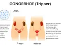 Darstellung von Gonorrhoe (Tripper) bei Frauen und Männern mit Symptomen wie Unterleibsschmerzen, Ausfluss und Entzündungen.