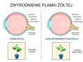 Porównanie normalnego oka z suchym zwyrodnieniem plamki żółtej. Obrazek pokazuje, jak obrzęk plamki żółtej wpływa na widzenie.