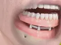 Implant zębowy: Bez bólu i strachu? Poznaj 5 etapów zabiegu