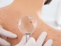 Dermatolog bada znamię na plecach pacjenta przez lupę. Skóra pokryta jest licznymi piegami i znamionami.