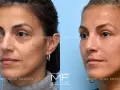 Before and after images show a woman's face, highlighting the reduction of nasolabial folds after a facial massage.