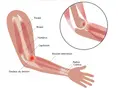 Illustration anatomique montrant une tendinite à l'intérieur du coude, avec douleur au tendon des muscles extenseurs.