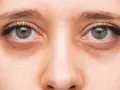 Primer plano de unos ojos con ojeras marcadas. Consejos para como quitar ojeras y lucir una mirada más descansada.