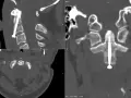 Widok CT kręgosłupa szyjnego po operacji. Widoczny implant stabilizujący, śruba przechodzi przez ząb obrotnika.