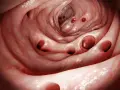 Darstellung des Darms mit Divertikeln. Buscopan kann bei Divertikulitis Linderung verschaffen.
