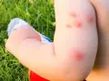 Bebé con varias picaduras de mosquito rojas e inflamadas en su brazo, jugando en el césped.
