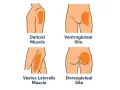 Illustration zeigt Injektionsstellen für eine Muskel-Spritze: Deltamuskel, Ventrogluteal, Vastus lateralis und Dorsogluteal.