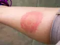 Borrelien Symptome beim Menschen: Warnzeichen, die Sie nicht ignorieren sollten