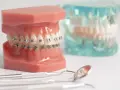 Model szczęki z aparatem ortodontycznym, narzędzia stomatologiczne i przezroczysty model zębów. Aparat ortodontyczny NFZ może pomóc w osiągnięciu pięknego uśmiechu.
