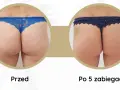 Porównanie pośladków przed i po 5 zabiegach endermologii. Widoczna poprawa jędrności i redukcja cellulitu.