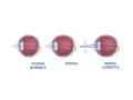 Diagrammi oculari mostrano visione normale, miopia e miopia corretta. I sintomi della miopia degenerativa sono visibili nel secondo occhio.