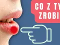 Jak skutecznie pozbyć się pryszcza na ustach i uniknąć infekcji