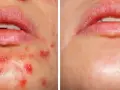 Przed i po: kwas salicylowy na co? Skóra wokół ust z wypryskami i zaczerwienieniami po kuracji czysta i gładka.