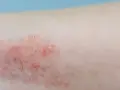 Alergia u dziecka: Jaki lek wybrać? Kiedy do lekarza?
