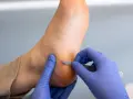 Un podologue enlève délicatement une croute sur le talon d'un pied avec un scalpel.