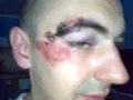 Rozcięty łuk brwiowy z siniakiem i otarciem na policzku.