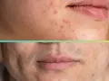 Primo piano di un volto con macchie da acne, prima e dopo il trattamento dermatologico.