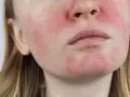 Nahaufnahme eines Gesichts mit Rötungen und sichtbaren Poren, die auf Rosacea und fettige Haut hindeuten.
