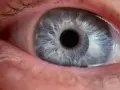 Occhio azzurro con iride dettagliata. Il trabeculectomia decorso post operatorio è in fase di guarigione, mostrando un occhio sano e vigile.