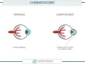 Confronto tra occhio normale e occhio con cheratocono, evidenziando la cornea assottigliata e a forma di cono, uno dei principali cheratocono sintomi.