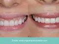 Uśmiech przed i po: zredukowany gummy smile, odsłonięte piękne, białe zęby.