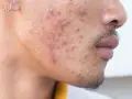 Primer plano de un rostro con acné severo, mostrando granos de pus grandes y enrojecimiento.