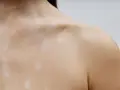 Piel con manchas claras, como si fueran **hongos en la espalda**, cubriendo el cuello y hombro.