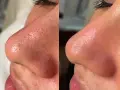 Before and after a hydro infusion facial, showing a nose with visible pores and blackheads transformed into smoother, clearer skin.