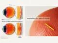 Illustrazione occhio sano vs. occhio con edema maculare diabetico, causa di edema retinico. Impianto microscopico.