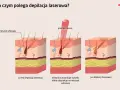 Ilustracja pokazuje, jak działa depilacja laserowa. Czy depilacja laserowa jest bezpieczna? Laser celuje w melaninę we włosie, niszcząc go.