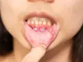 Aftę ustne, które mogą wymagać leczenia leukoplakii, widoczne na wewnętrznej stronie wargi dolnej.