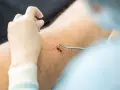 Chirurg zszywa ranę po usunięciu pieprzyka na nodze. Widoczna jest igła z nicią i narzędzia chirurgiczne.